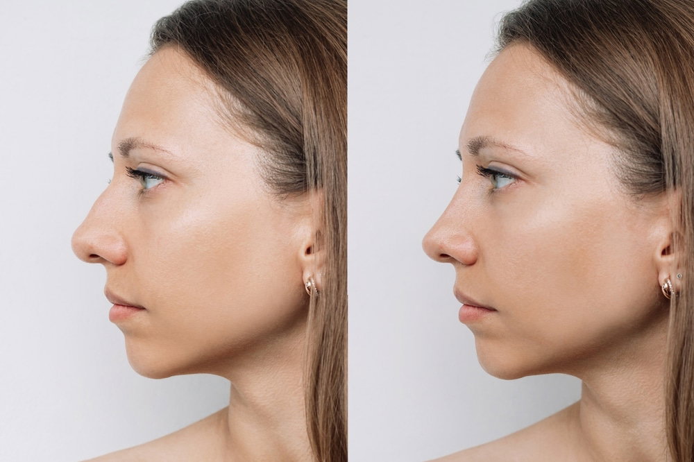 Post-Operative Care for Rhinoplasty: Essential Tips for a Smooth Recovery