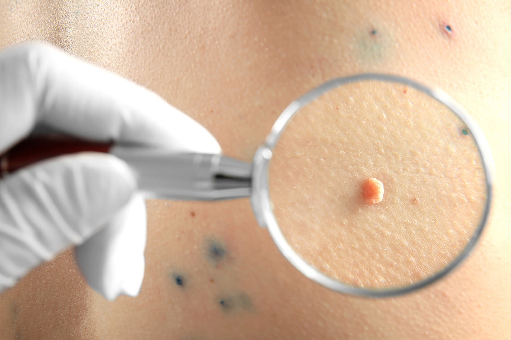 How Safe Is Skin Tag Removal for Children and Teens?