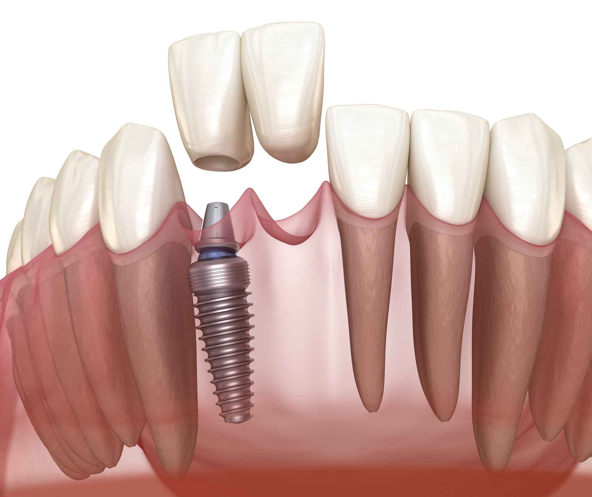 Step-by-Step: What to Expect During a Dental Implant Procedure
