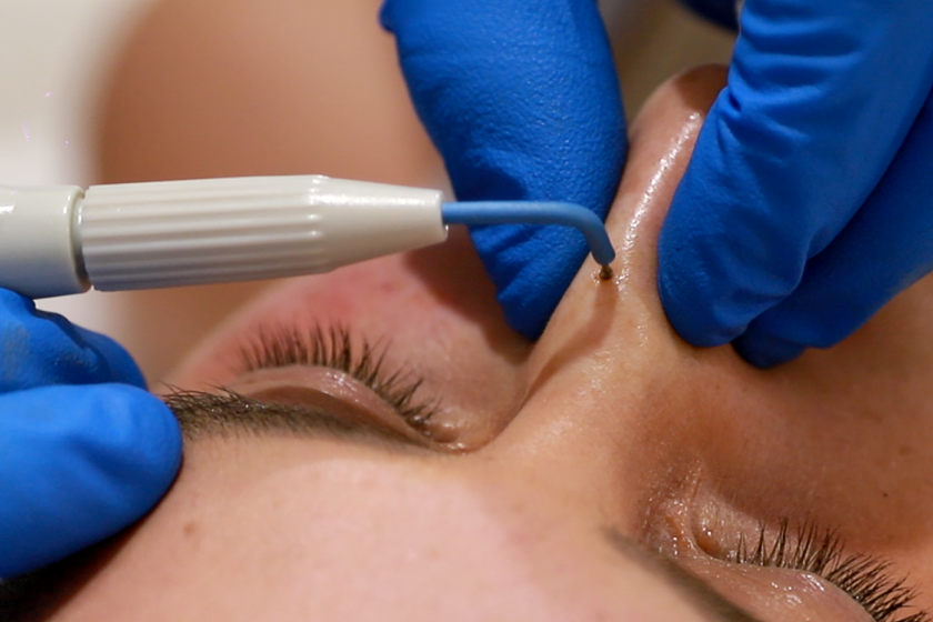 Is Skin Tag Removal Safe for People with Psoriasis?