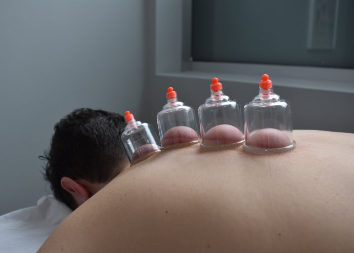 Say Goodbye to Toxins: Hijama for Clearer, Brighter Skin