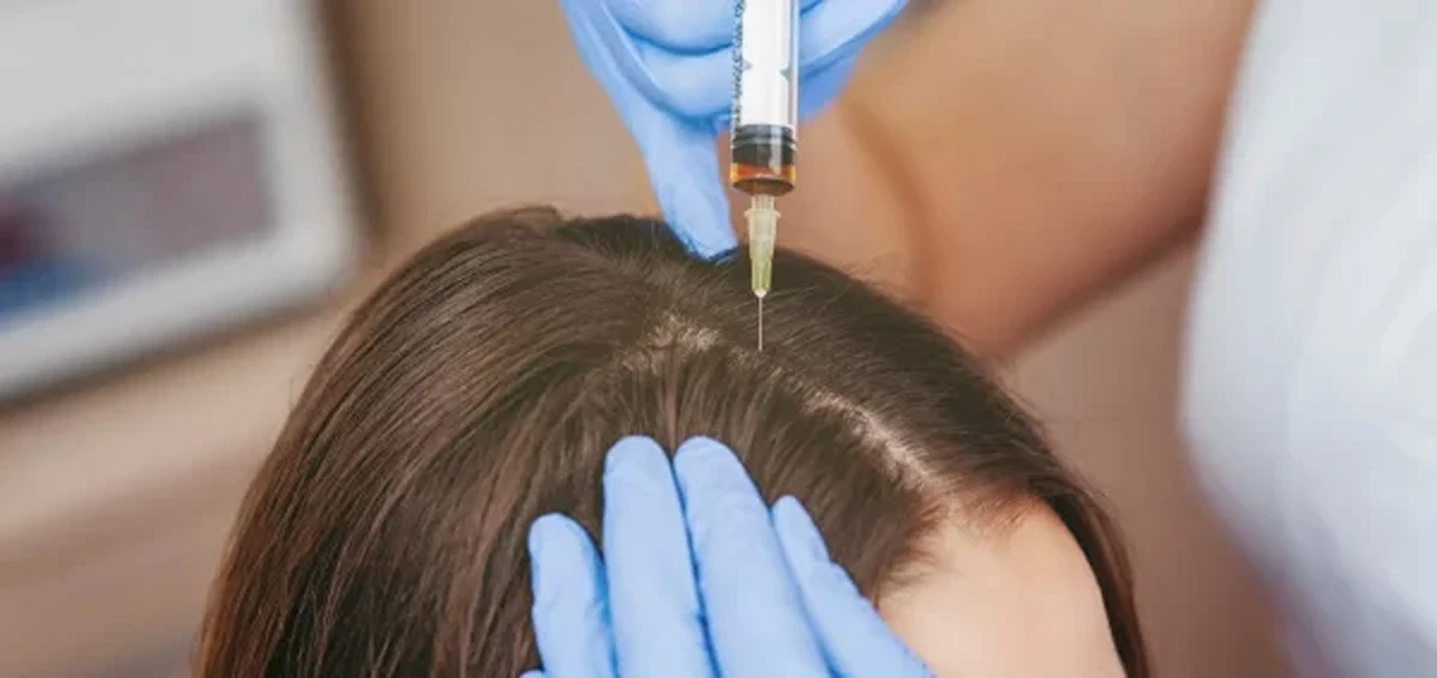 PRP: The Elite Solution to Hair Thinning