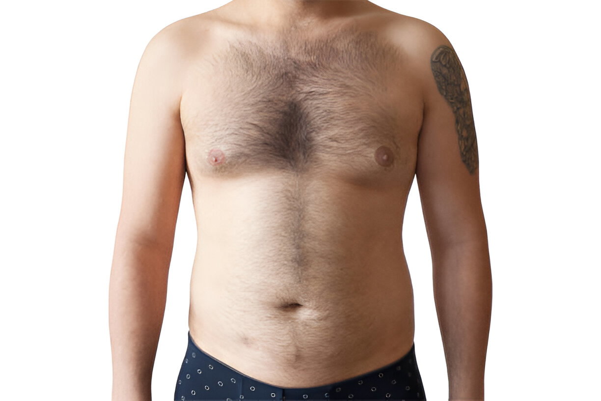 What Is Gynecomastia? A Simple Explanation for Men