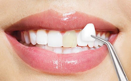 How Dental Veneers Can Enhance Your Smile Instantly