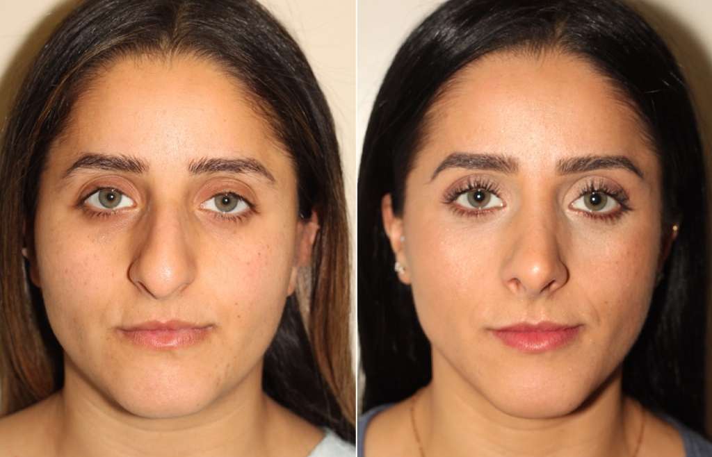 Rhinoplasty for Better Sleep and Reduced Snoring