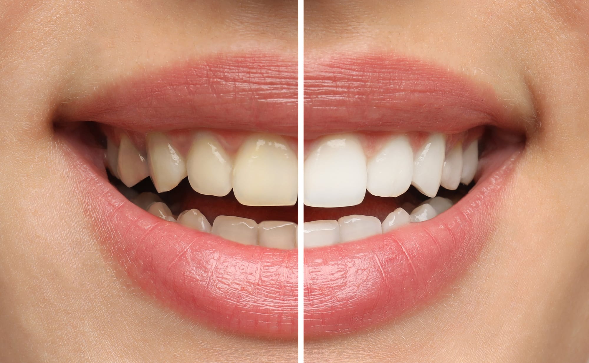 Can Teeth Whitening Treat Fluorosis and White Spots?