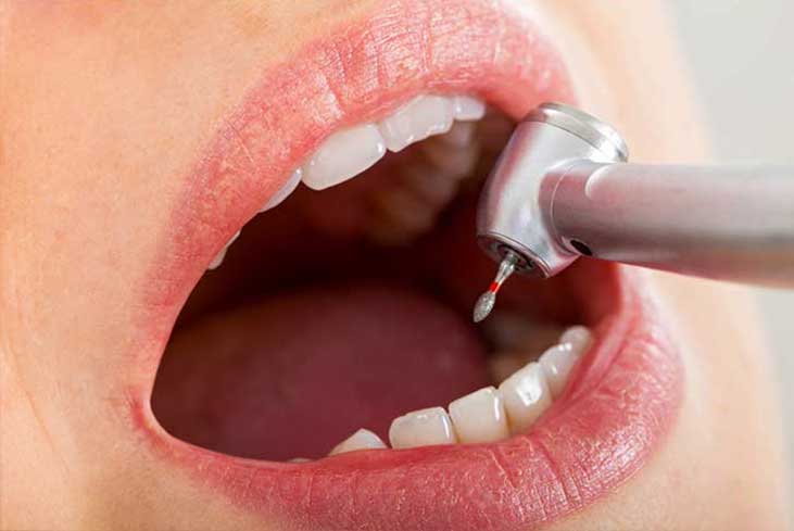 How Long Does a Dental Hygienist Cleaning Take?