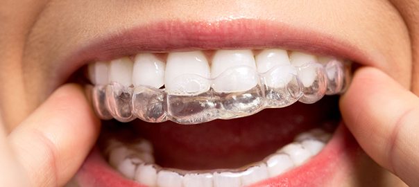 Invisalign Braces Treatment: Are Refinements Common?
