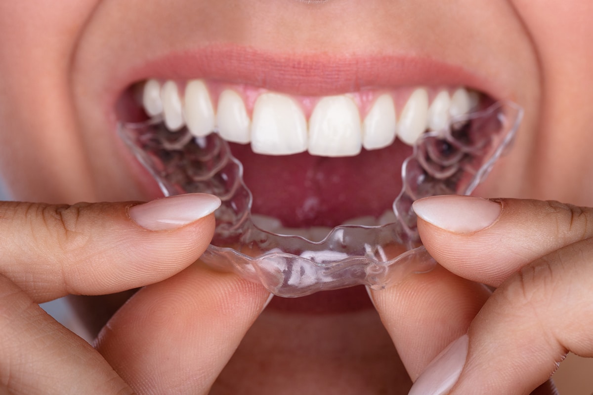 Invisalign Braces Treatment: Handling Dry Mouth Issues