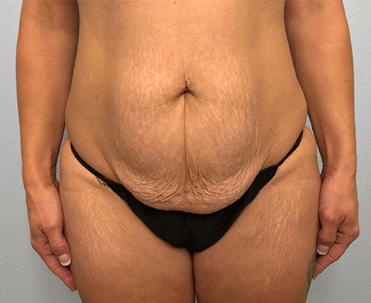 Tummy Tuck Scars: How to Minimize Visibility Effectively