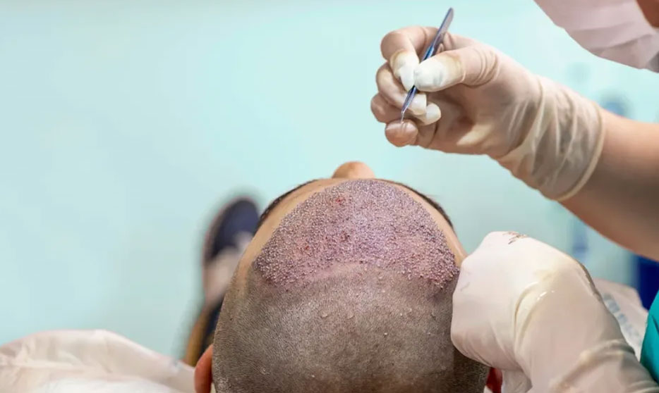 Hair Transplant for Receding Temples: What to Expect