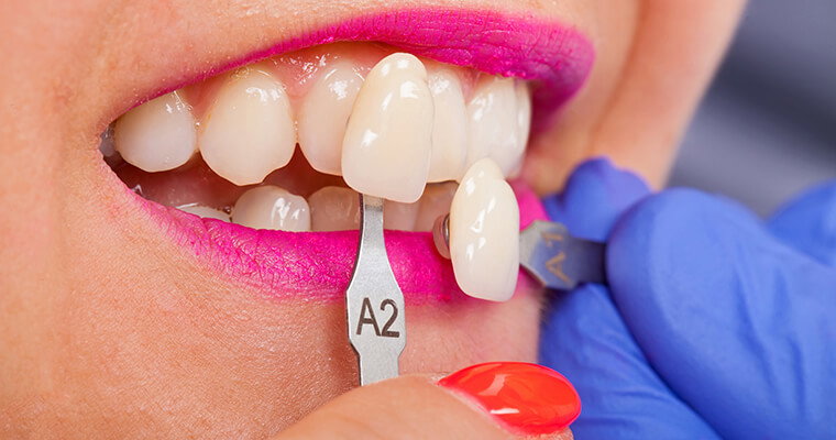 How Effective Are Dental Veneers for Uneven Teeth