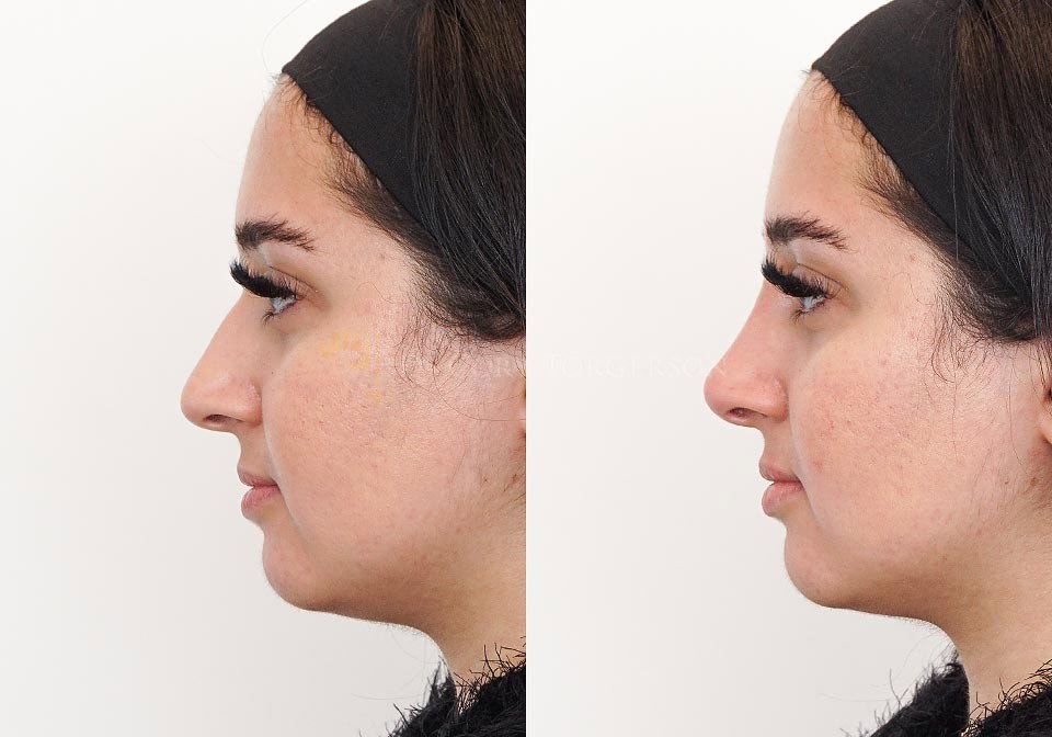 Can a Non-Surgical Nose Job Transform Your Profile With Instant Elegance?