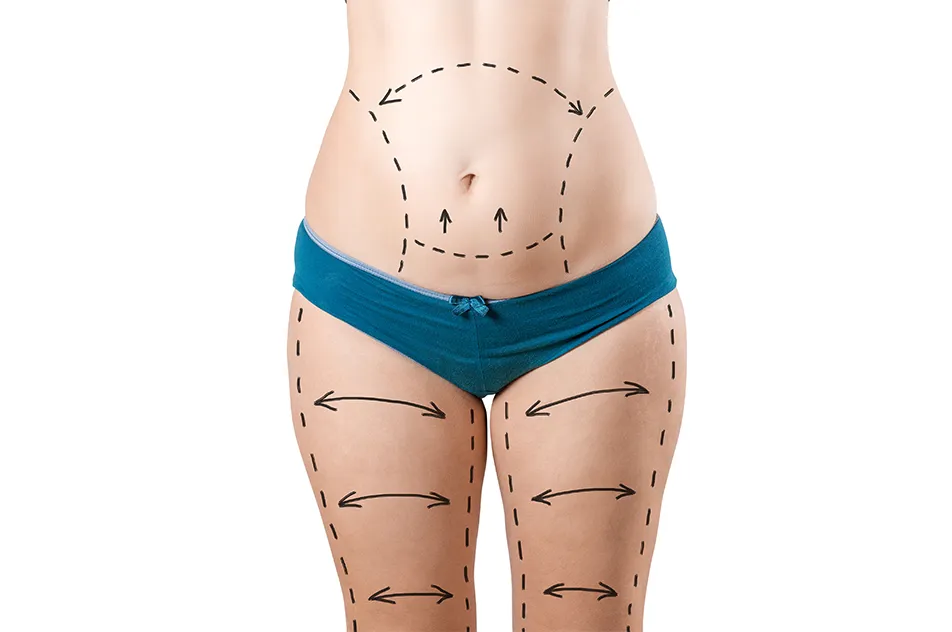 Liposuction Cost: Factors Patients Often Overlook