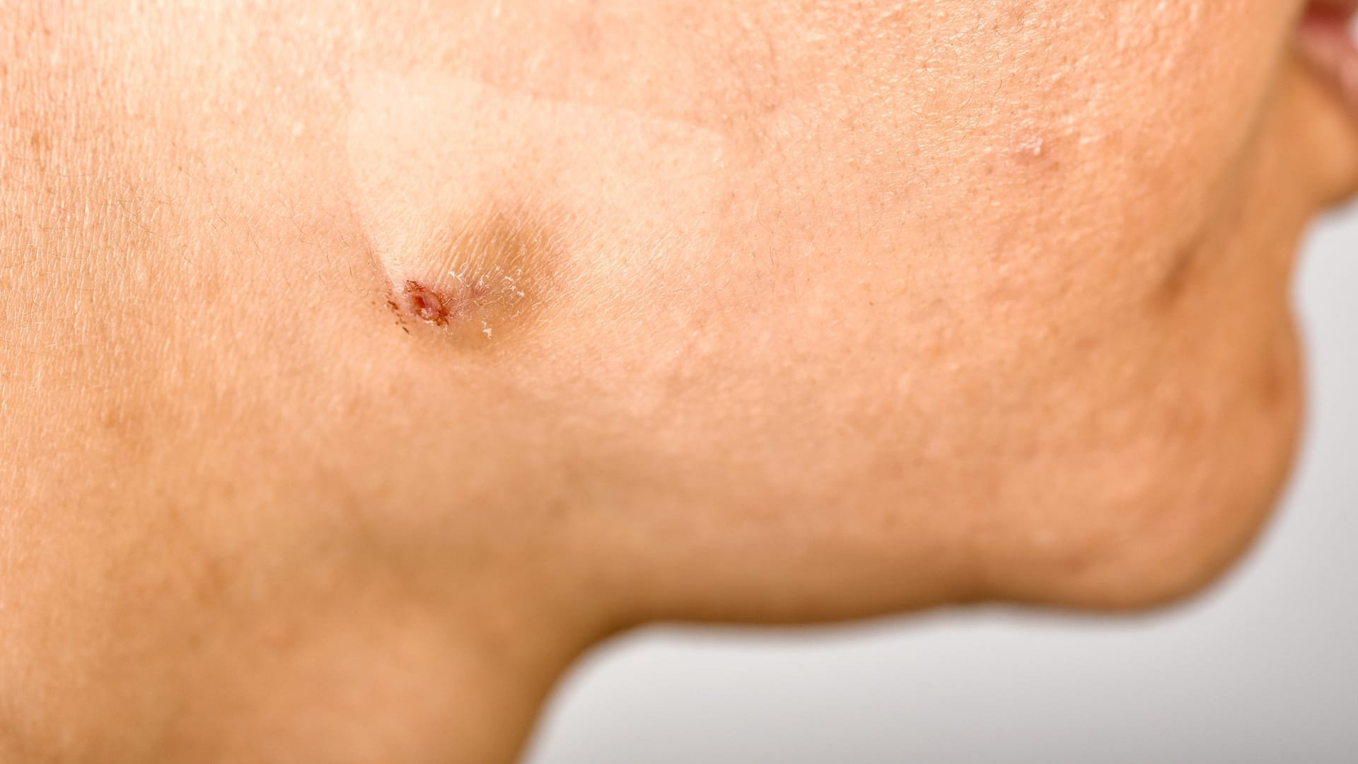 Natural Acne Treatment Options That Really Work