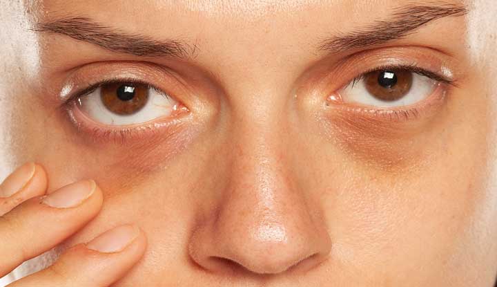 Eye Bag Removal: Understanding Under-Eye Fat