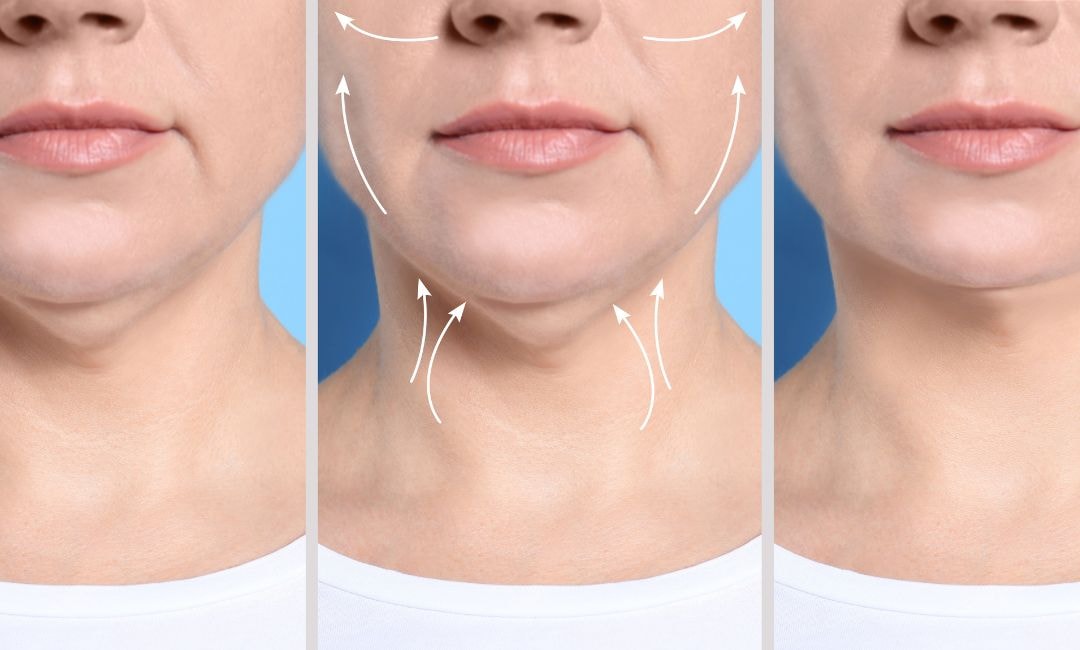 Who Is a Good Candidate for Kybella Treatment for a Double Chin