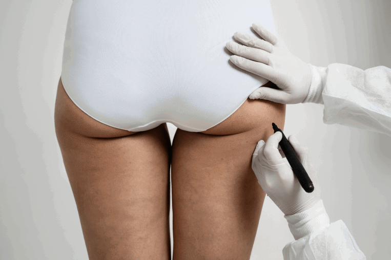 Why Choose the Best Clinic for Buttock Augmentation Surgery?