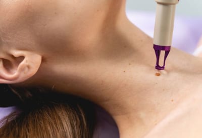 Is Skin Tag Removal the Same as Mole Removal?