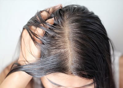 Is Finasteride Effective for Patchy Hair Loss?