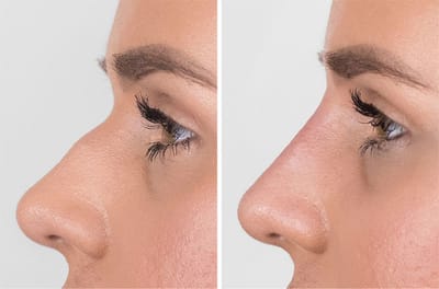 Is Rhinoplasty Considered Medically Necessary?