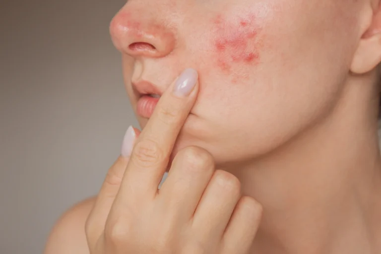 How to Incorporate Acne Treatment into Your Skincare
