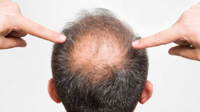 Are There Side Effects of Finasteride for Hair Loss?