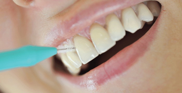 Avoiding Cavities with Routine Teeth Cleaning
