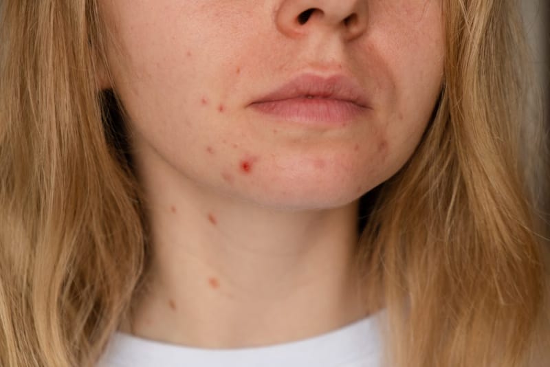 Best Acne Solutions for Dry Skin
