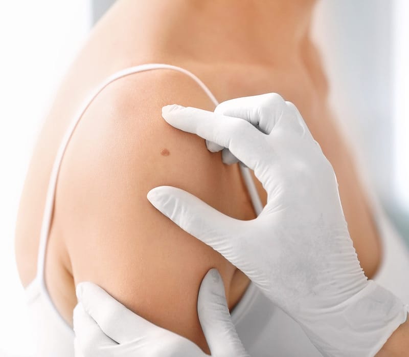 How to Choose the Best Skin Tag Removal Method for Your Skin Type