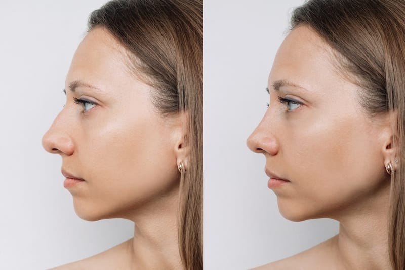 Post-Operative Care for Rhinoplasty: Essential Tips for a Smooth Recovery