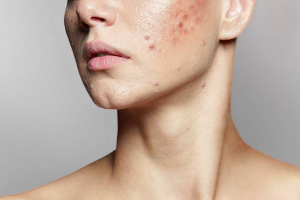 How to Select the Most Effective Acne Treatment for Your Skin?