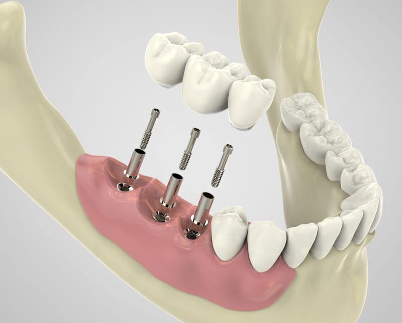 How Do Dental Implants Improve Chewing Efficiency in Dubai?
