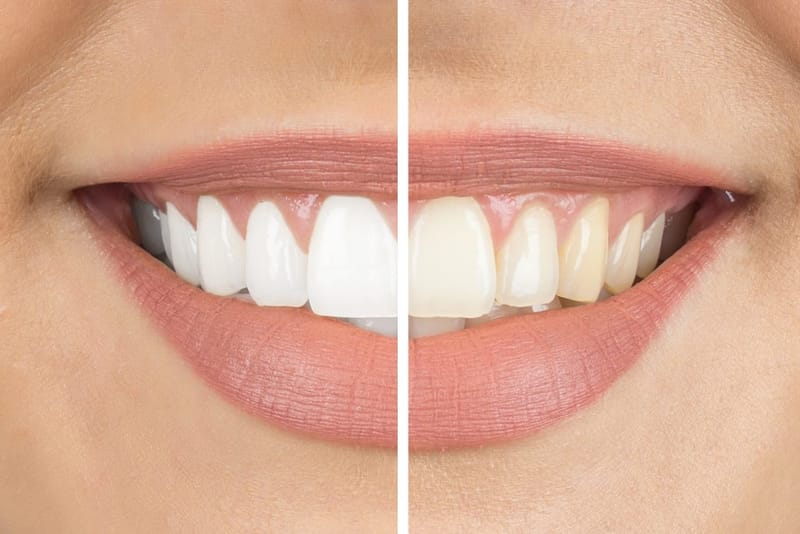 How Teeth Whitening Restores Youthful Brightness to Your Teeth