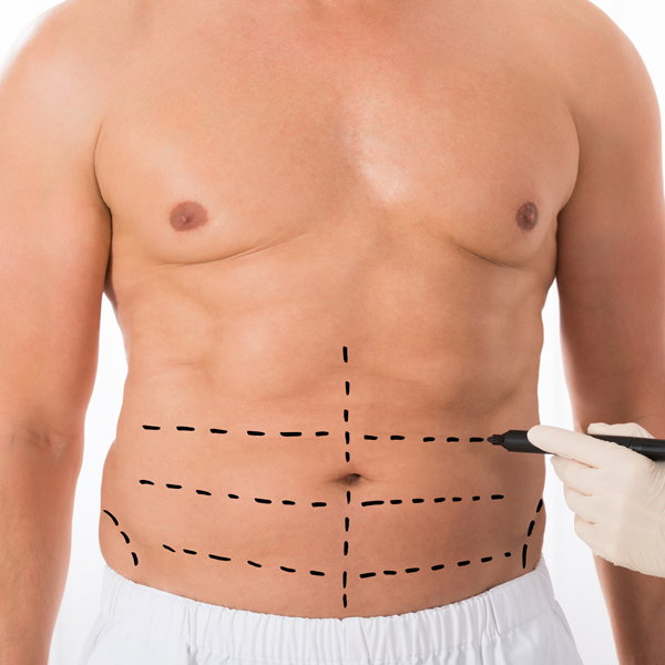 Curves Reimagined: Tummy Tucks for the Modern Body