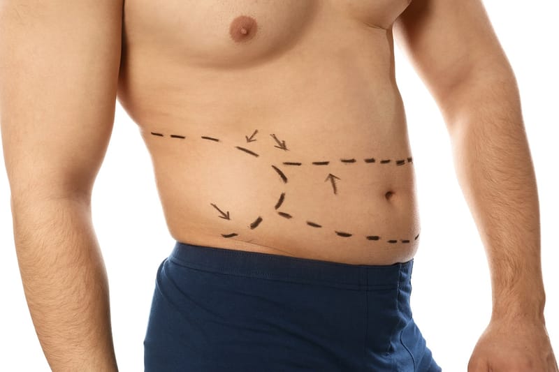 Flat Abs Without Crunches: Is a Tummy Tuck Right for You?