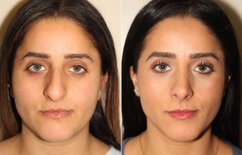 Rhinoplasty for Better Sleep and Reduced Snoring