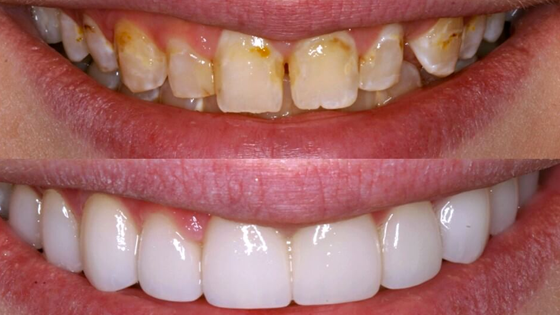 Do Dental Veneers Work on Heavily Stained Teeth?