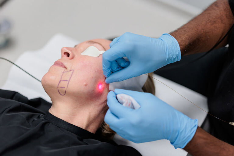 Can Endolift Help Restore Confidence in Your Facial Appearance?