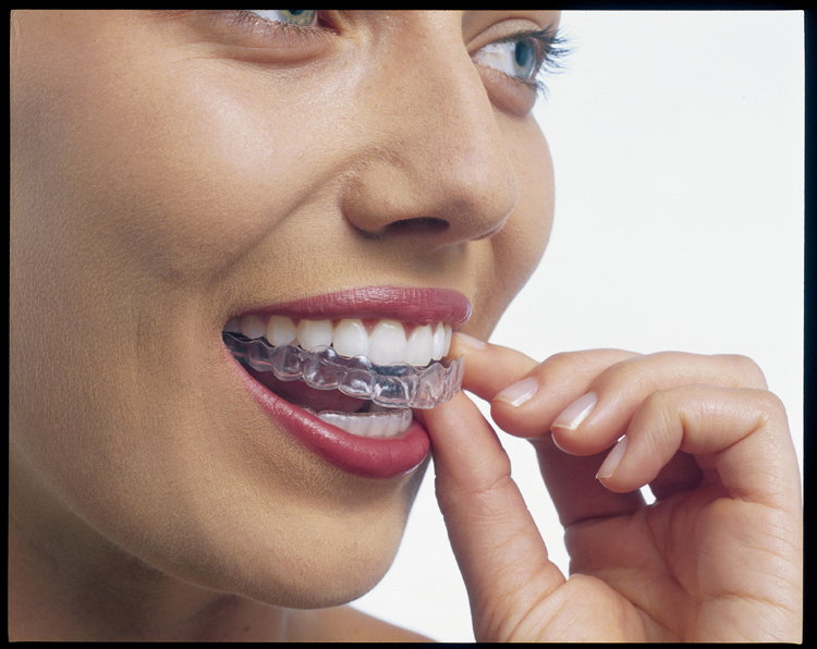 Can Invisalign Braces Treatment Correct Overbite Problems?