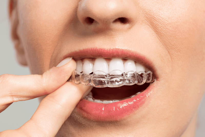 How Invisalign Braces Treatment Changes Your Smile Gradually