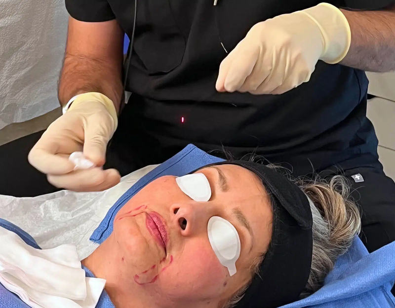Endolift for Jawline and Cheek Sculpting: Key Insights