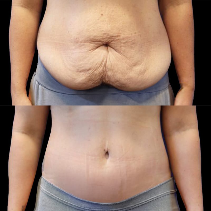 How Tummy Tuck Works for Men’s Abdominal Definition