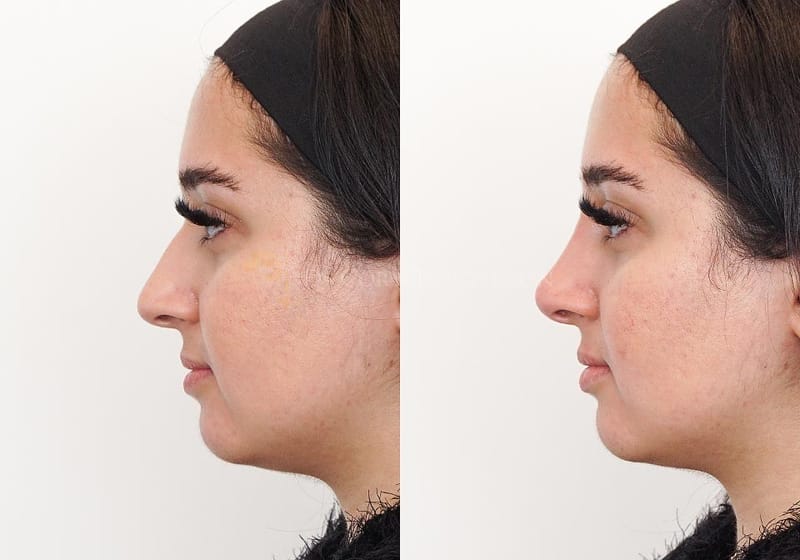 Can a Non-Surgical Nose Job Transform Your Profile With Instant Elegance?