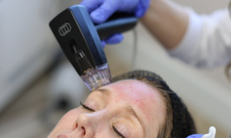 Morpheus8 for Full Face Skin Rejuvenation