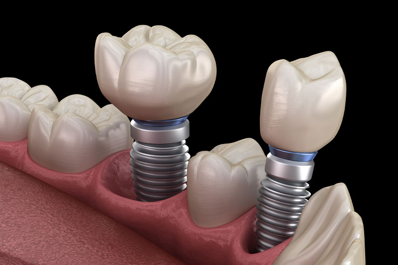 Dental Implants Aftercare: Best Practices for Long-Lasting Results