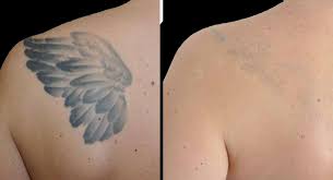 Laser Tattoo Removal: What Makes a Tattoo Hard to Remove?
