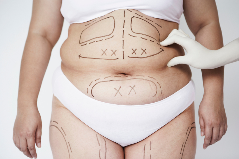 Liposuction Cost and Treatment Scope: How They Relate