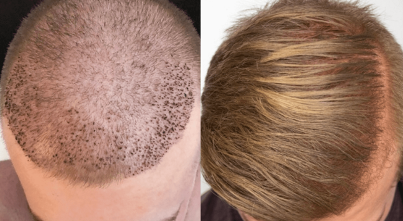 Hair Transplant for Mature Hairlines Explained