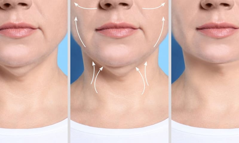 Who Is a Good Candidate for Kybella Treatment for a Double Chin